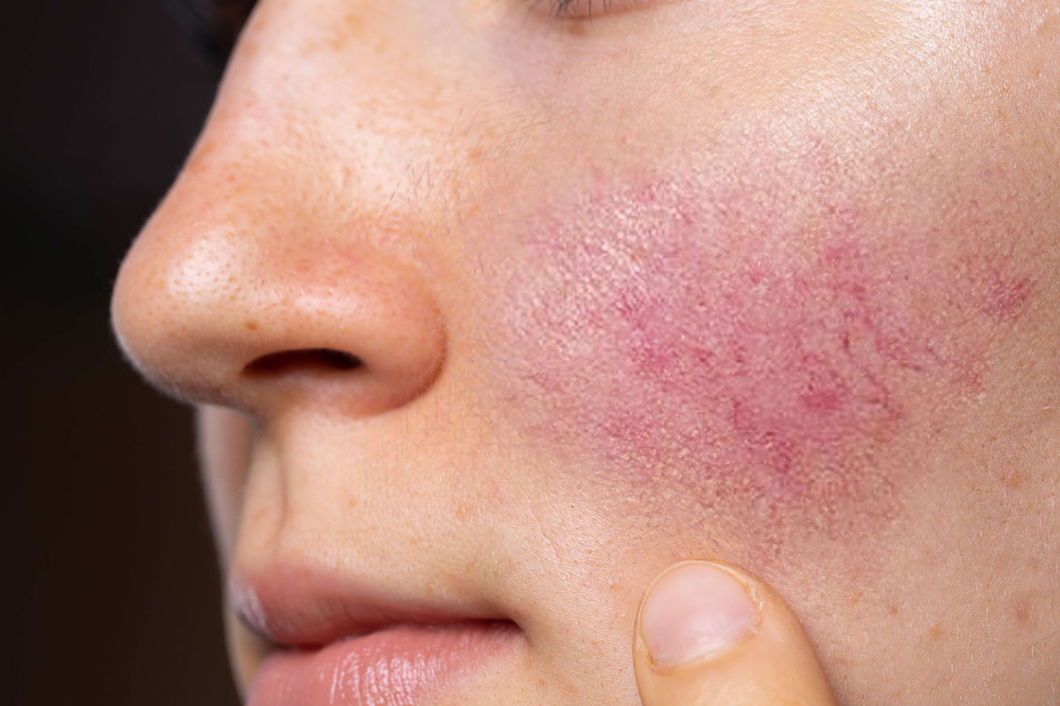 tratamiento medico para curar la rosacea